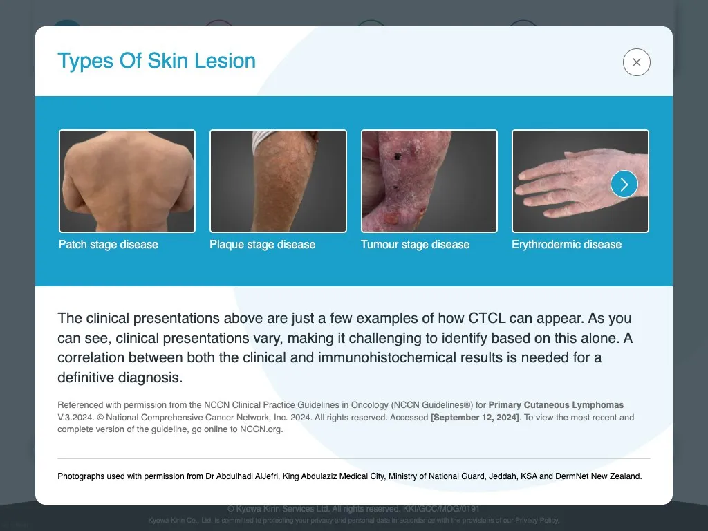 Popup showing example CTCL skin lesion types with clinical images